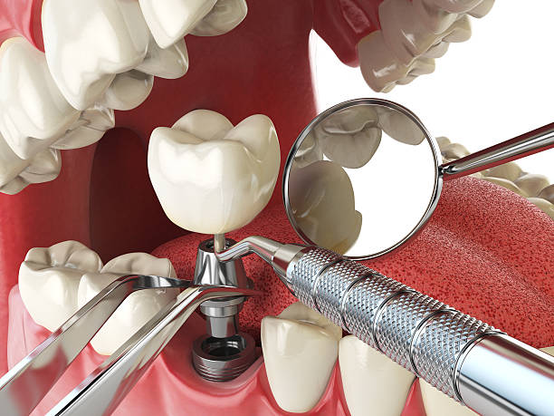 Best Emergency Dental Care for Broken or Chipped Teeth in St City, AR